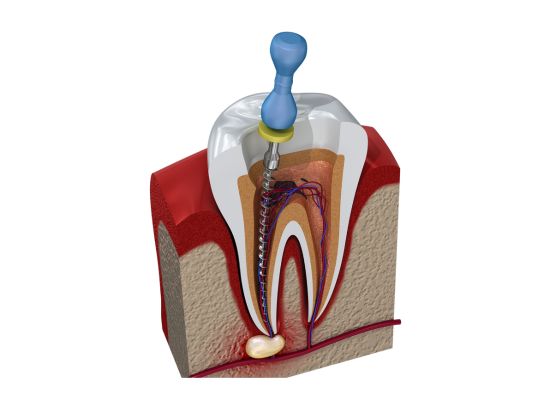 Root Canal Treatment in Boynton Beach